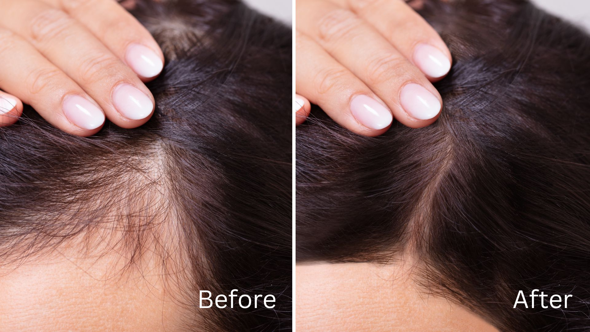 female pattern hair loss